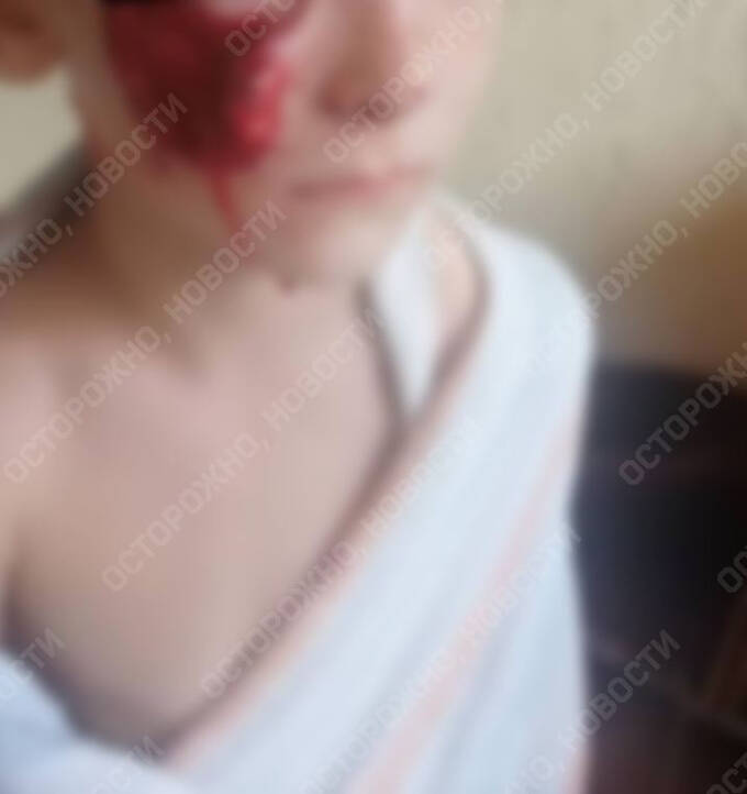 В Саратове собака депутата «Единой России» напала на 6-летнего ребёнка