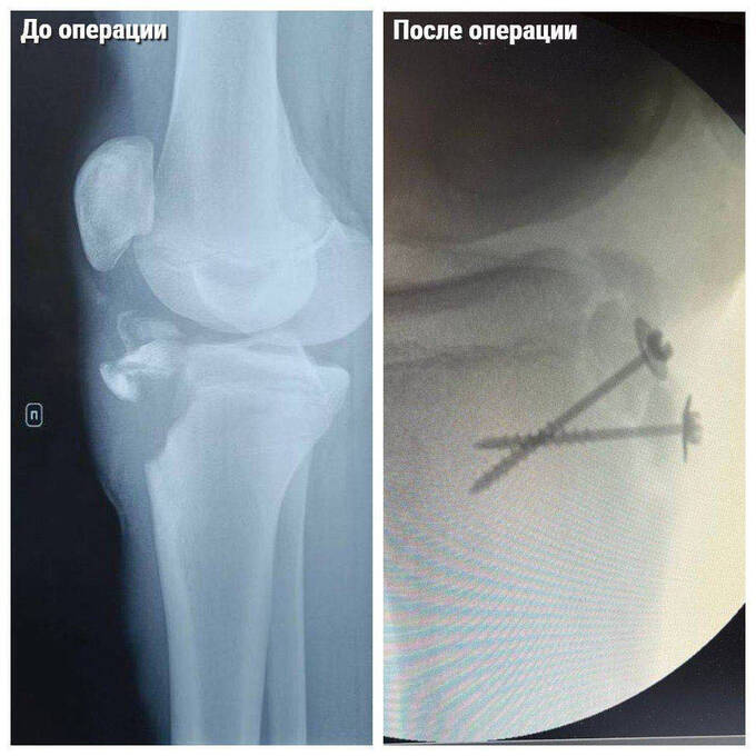 У подмосковного школьника оторвалась часть кости на ноге из-за тренировки без разминки qkxiqdxiqdeihrkrt